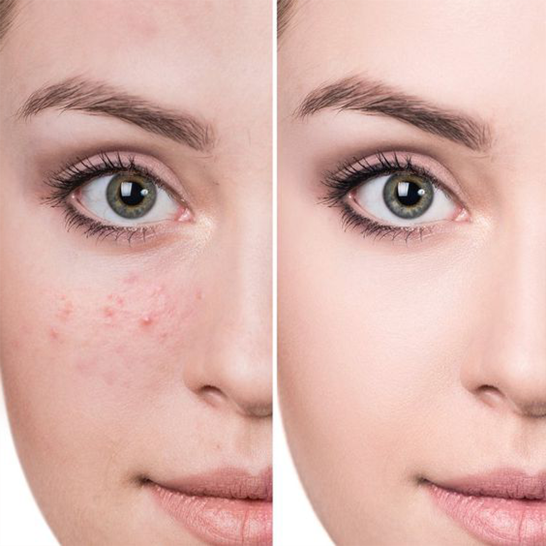 Anti Acne Cream - 50 ML Neolithbeauty